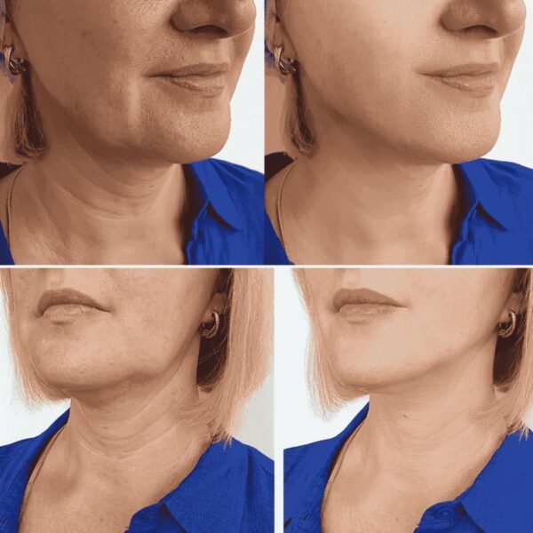 Creme Suavizador de Papada – Reshape Double Chin - Imagem 3